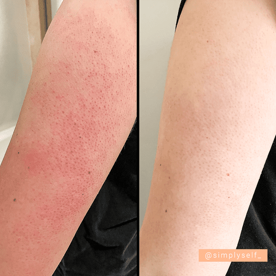 Before and after results using Simply Self Silky Smooth Body Scrub on arm showing improved skin clarity and softness.